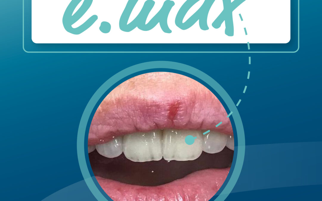 Zack – neuer Frontzahn in e.max!
