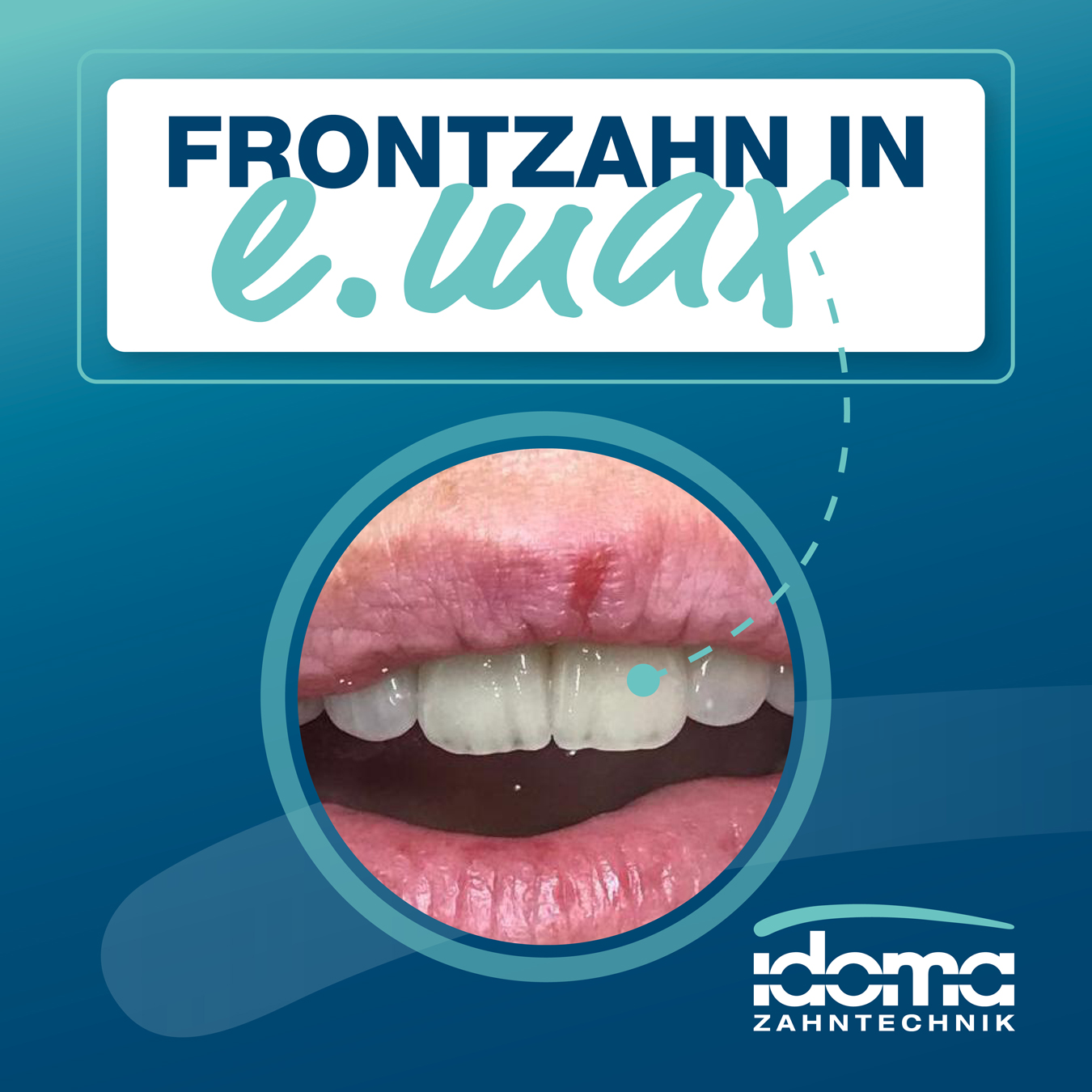 IDOMA - News -Zack – neuer Frontzahn in e.max!