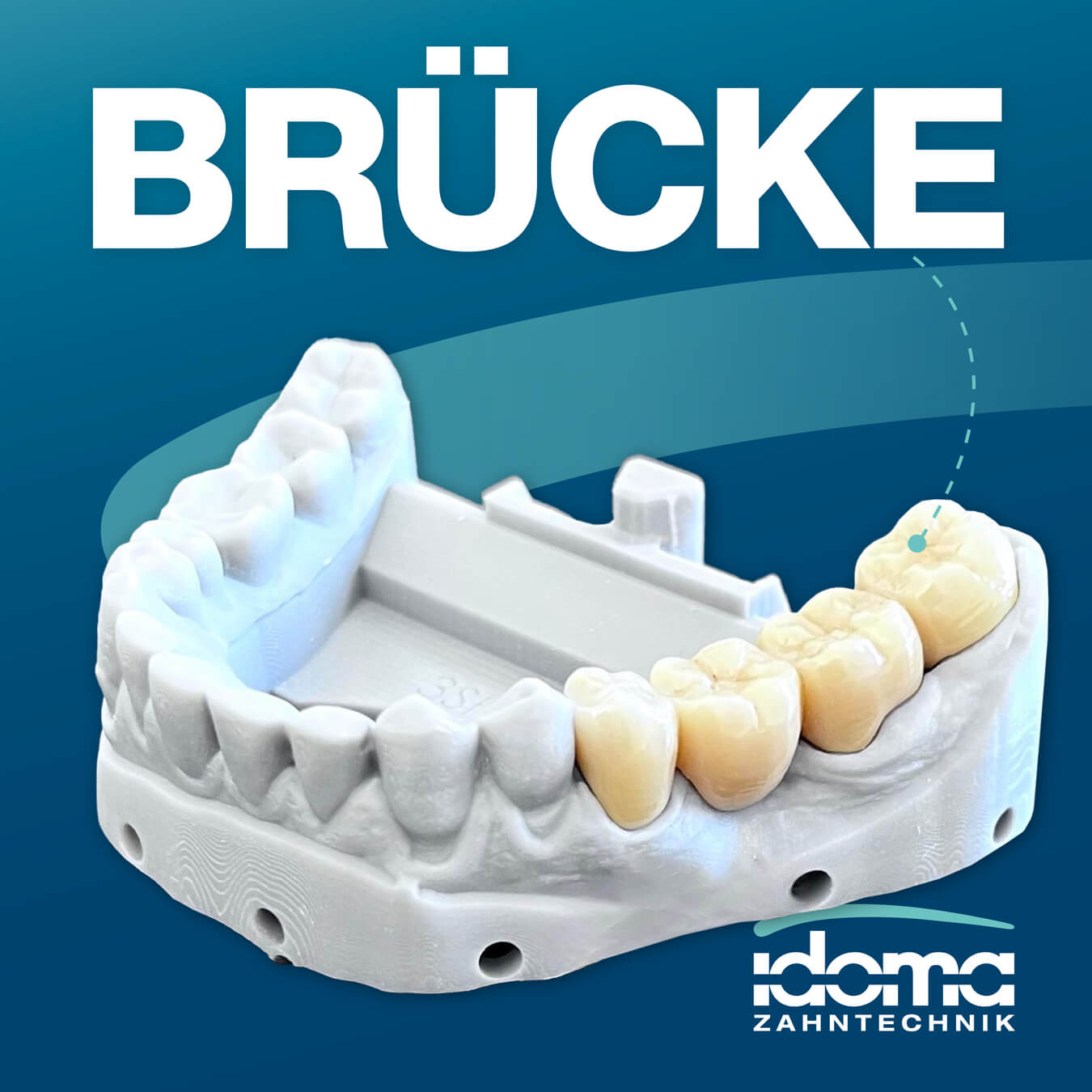 IDOMA Dental News – Schick schick! – Brücken von IDOMA