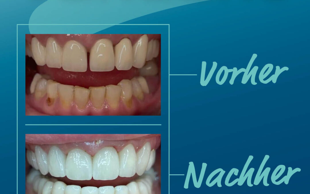 Strahlend schön dank Veneers!