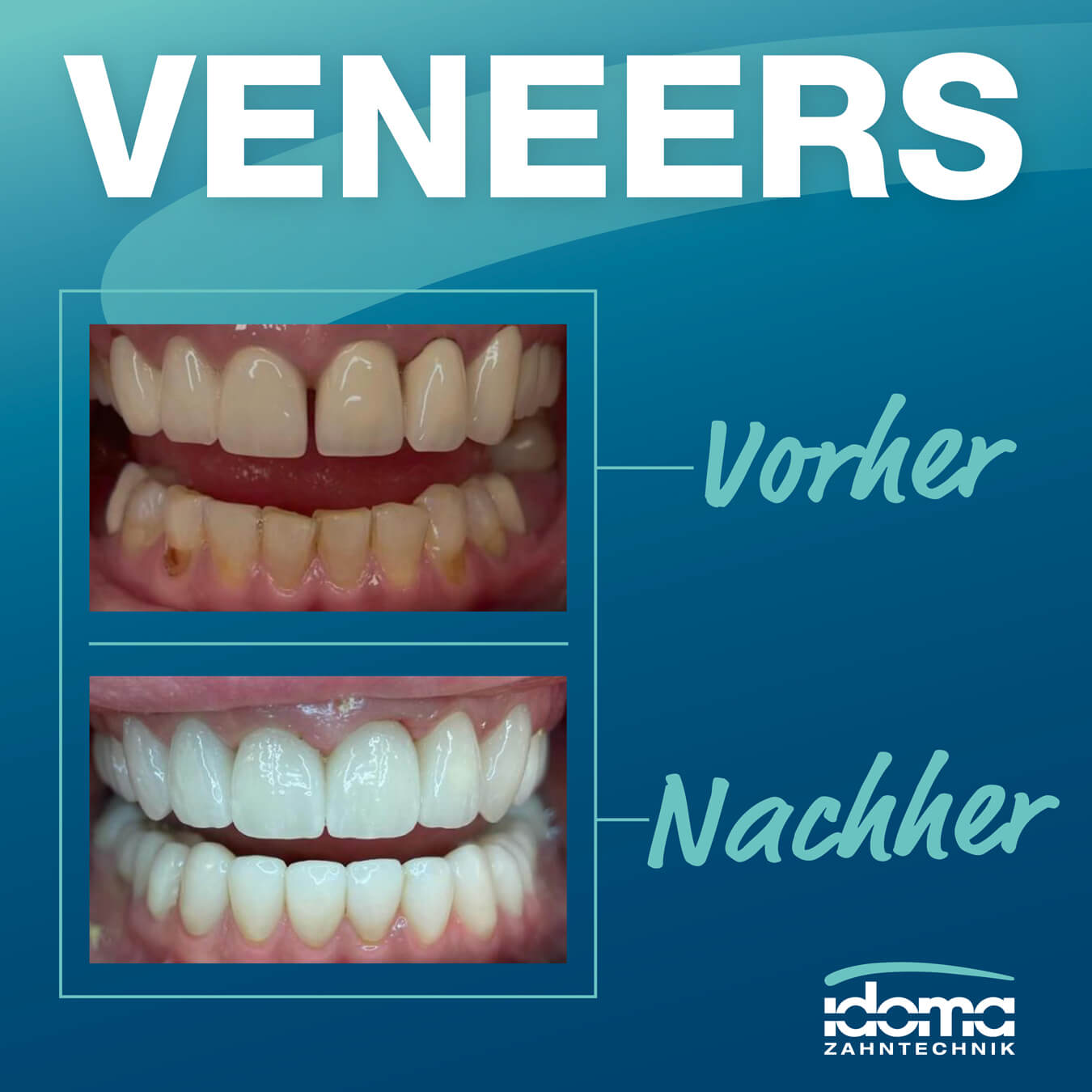 IDOMA Dental News – Strahlend schön dank Veneers!