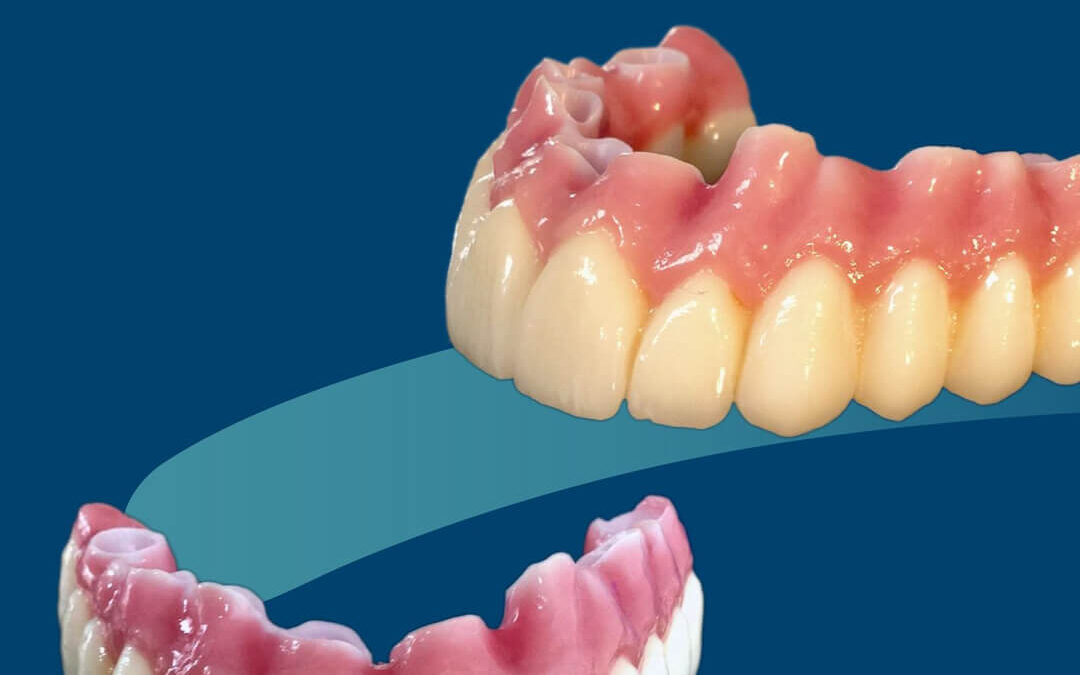 So schön können Implantatbrücken sein!