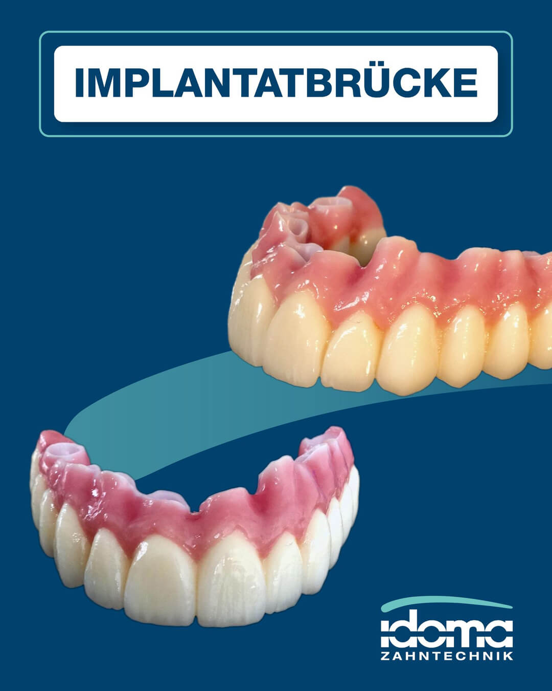 IDOMA Dental - News - So schön können Implantatbrücken sein!