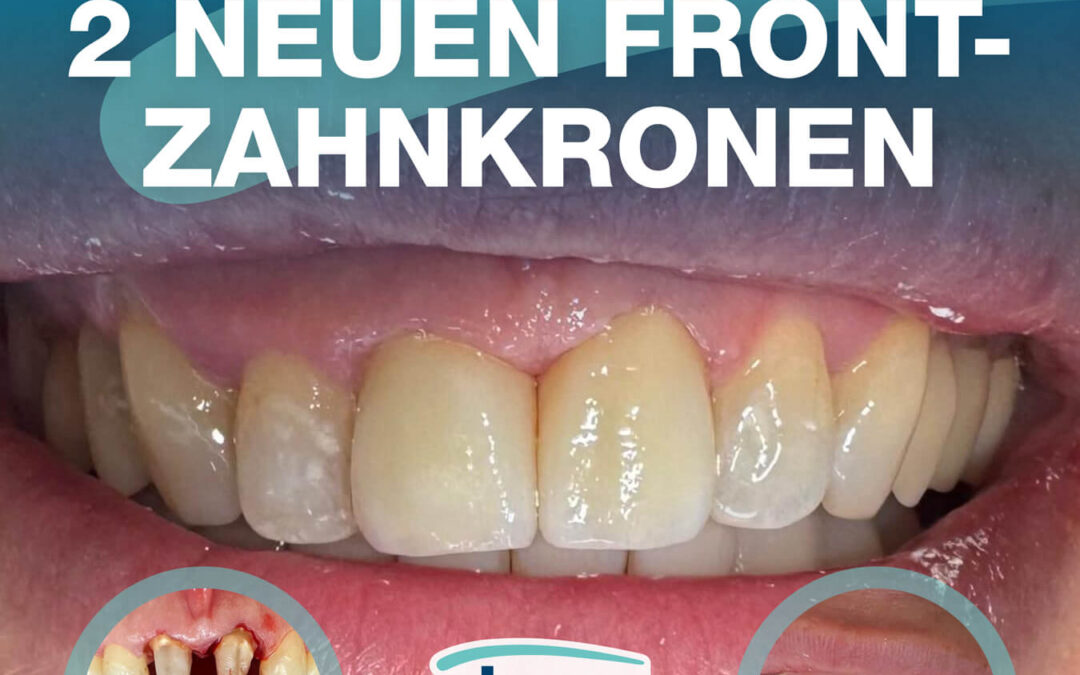 Neues Lächeln, natürliche Wirkung!