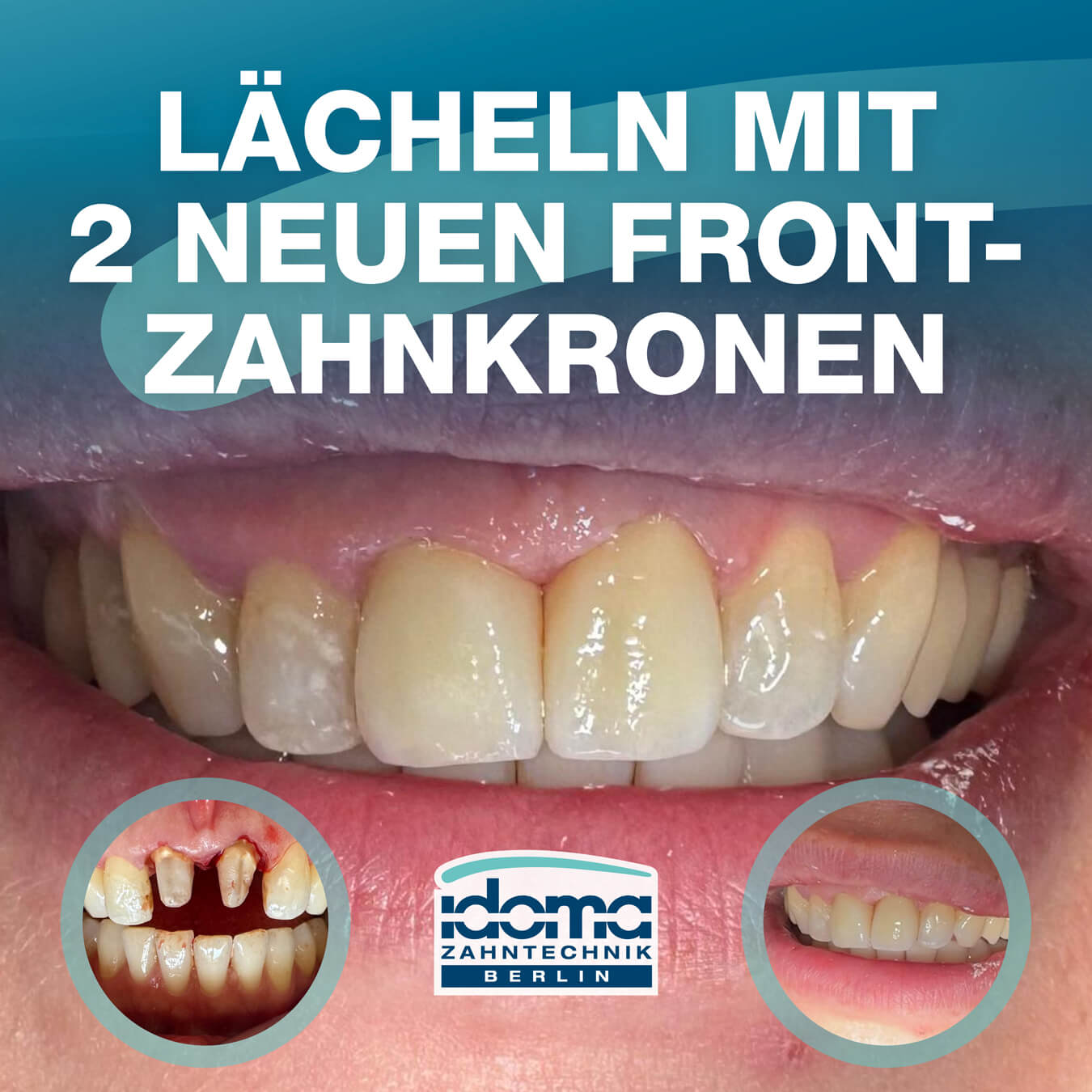 IDOMA Zahntechnik - News - Frontzahnkronen